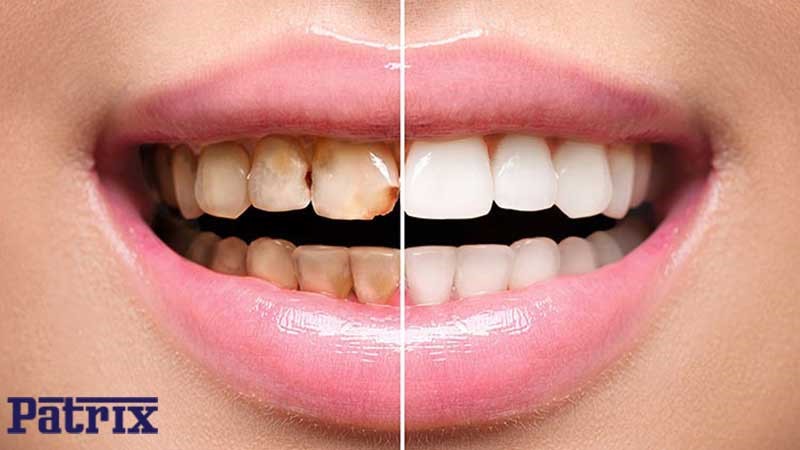 روش‌های جلوگیری و درمان پوسیدگی دندان