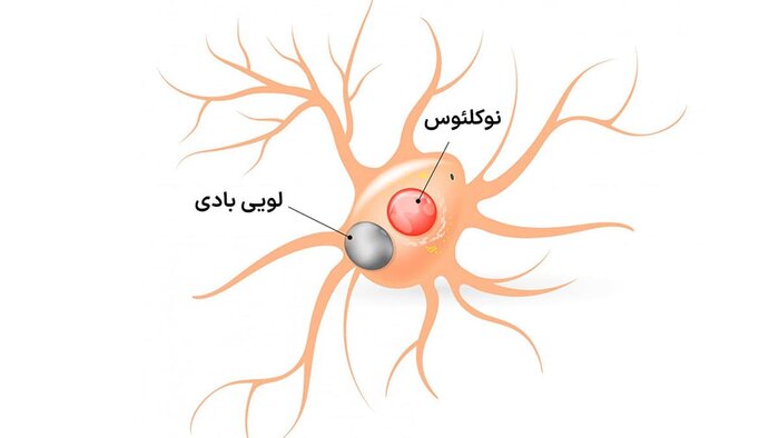 پارکینسون