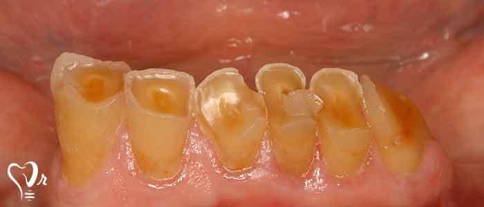 چگونه از دندان و لثه خود مراقبت کنیم