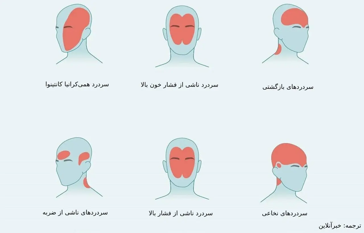سردرد