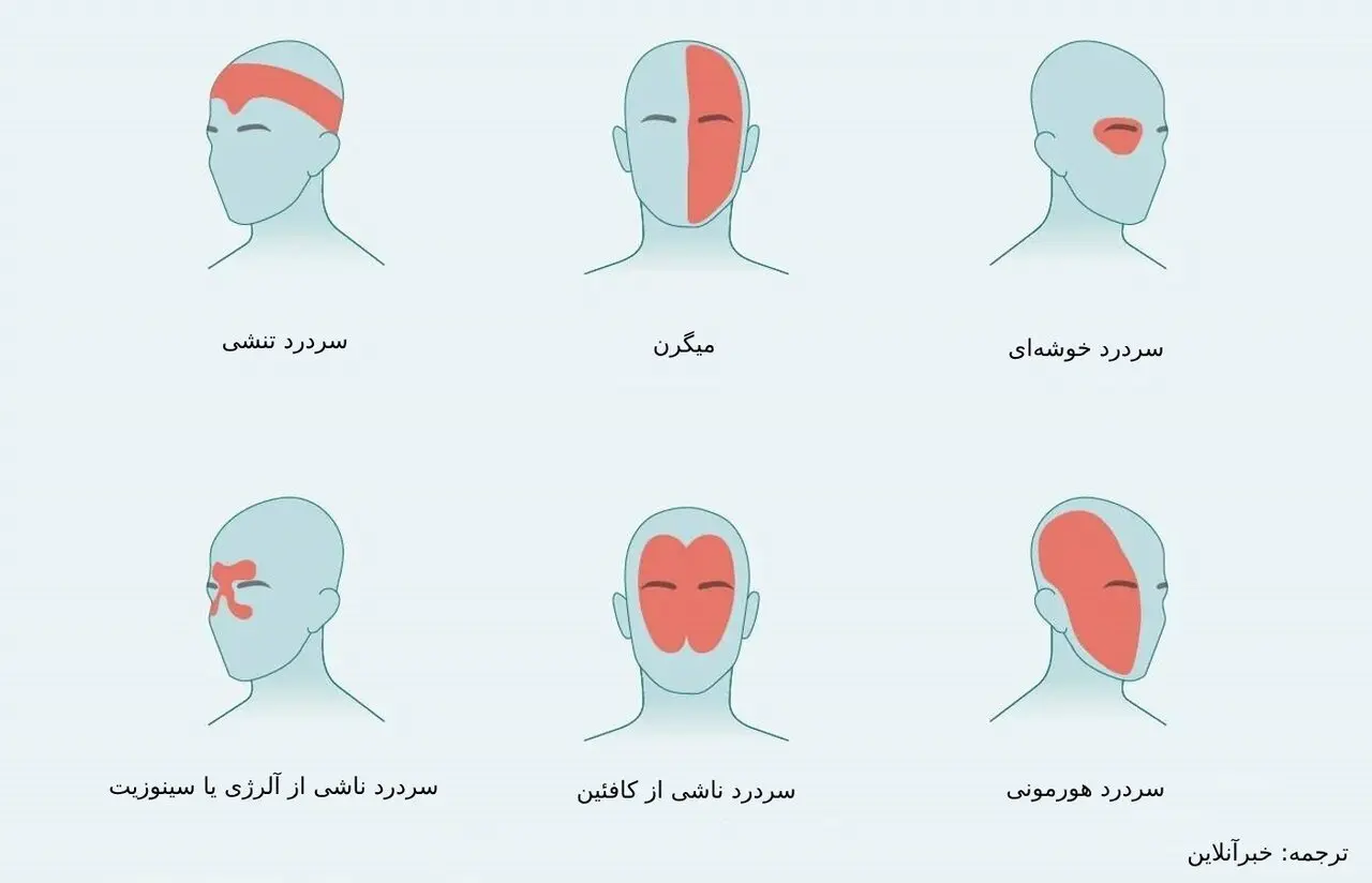 سردرد