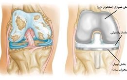 آشنایی با تعویض مفصل زانو و فوق‌تخصص زانو