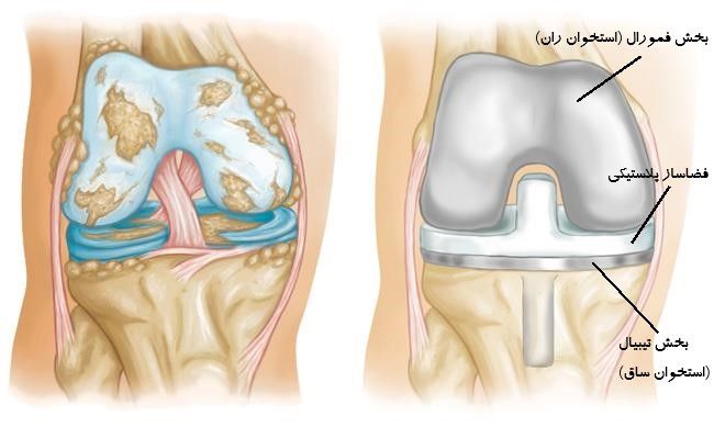 آشنایی با تعویض مفصل زانو و فوق‌تخصص زانو