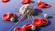 روش جدید درمان سرطان خون کشف شد
