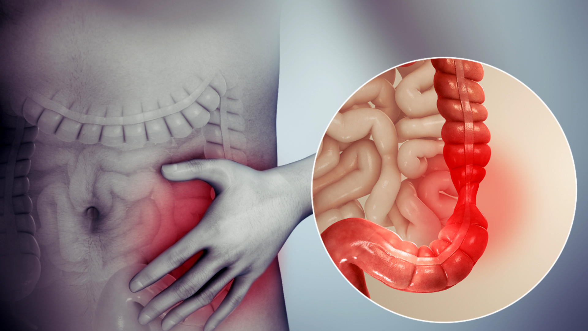 چه چیزی باعث التهاب روده می شود؟