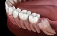 درنیامدن دندان عقل چه عواقب و مشکلاتی دارد؟