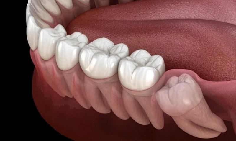 درنیامدن دندان عقل چه عواقب و مشکلاتی دارد؟