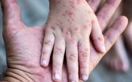 هشدار وزارت بهداشت درباره شیوع یک بیماری ویروسی خطرناک | کودکان در خطر