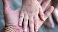 هشدار وزارت بهداشت درباره شیوع یک بیماری ویروسی خطرناک | کودکان در خطر