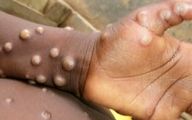 واکسن آبله میمونی تایید شد