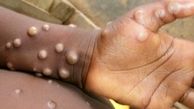 واکسن آبله میمونی تایید شد