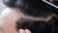 علت اصلی شوره زدن موی سر 