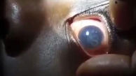 بیماری ترسناک کرم چشم! +فیلم