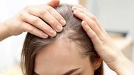 ریزش مو نشانه چه بیماری است؟