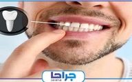 آیا ایمپلنت دندان نیاز به مراقبت ویژه دارد؟【سال1402】