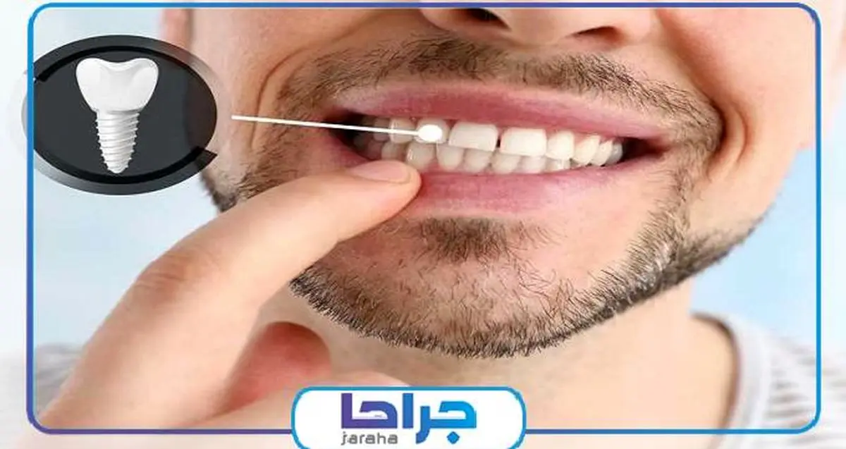 آیا ایمپلنت دندان نیاز به مراقبت ویژه دارد؟ سال1402