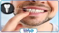 آیا ایمپلنت دندان نیاز به مراقبت ویژه دارد؟【سال1402】
