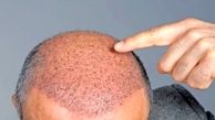 نکات مهمی که قبل از کاشت مو باید بدانید | عوارض کاشت مو چیست؟