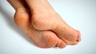 خشکی پا را در سه سوت درمان کنید