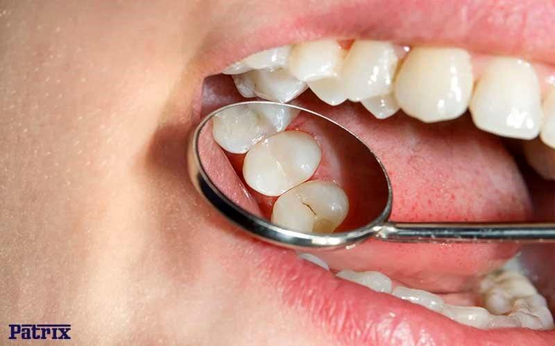 برای جلوگیری از پوسیدگی دندان‌ها چه راهکارهایی وجود دارد؟!
