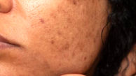 درمان ملاسما با روش های خانگی + انواع و علل ملاسما روی پوست

