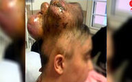 خروج تومور ۳.۵ کیلویی از مغز ستایش 13 ساله در یزد + عکس