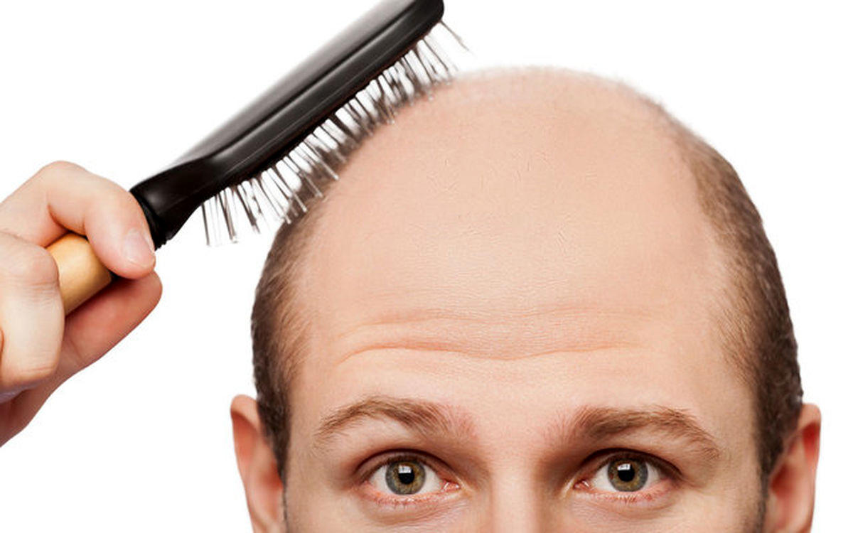چه عواملی که باعث ریزش موها می شود؟
