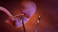 10 خطر جدی سقط جنین؛ از ابتلا به سرطان تا ناباروری دائم+عکس