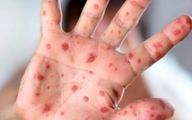هشدار درباره شیوع یک ویروس کشنده در بین کودکان ایرانی | هر چه سریع تر کودکان زیر ۵ سال را واکسینه کنید