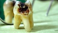 چرا دندان‌های اکثر ایرانی‌ها خراب است؟!