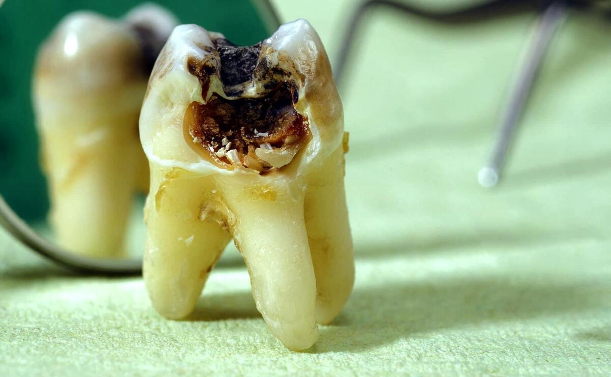 چرا دندان‌های اکثر ایرانی‌ها خراب است؟!