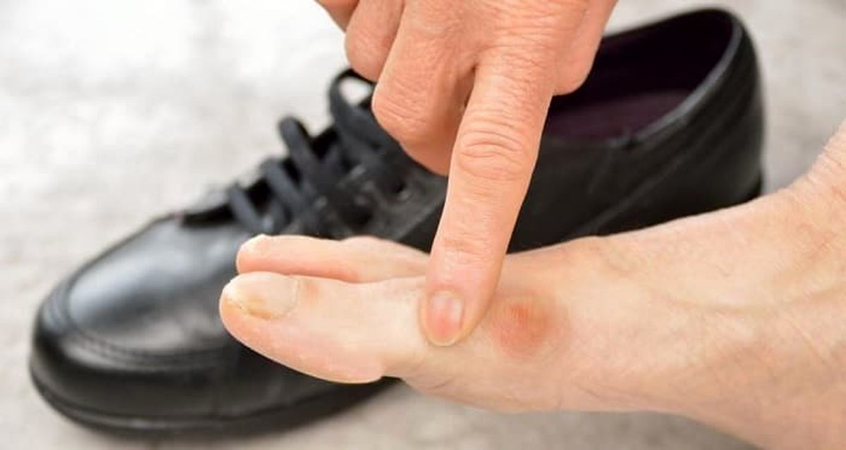 هشدار؛ عوارض خطرناک کفش نامناسب برای سلامتی / از بیماری عفونی تا پوستی
