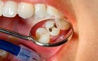 علائم اولیه پوسیدگی دندان را بشناسید