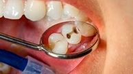 مهمترین عامل جلوگیری کننده از پوسیدگی دندان

