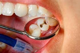 علائم اولیه پوسیدگی دندان را بشناسید