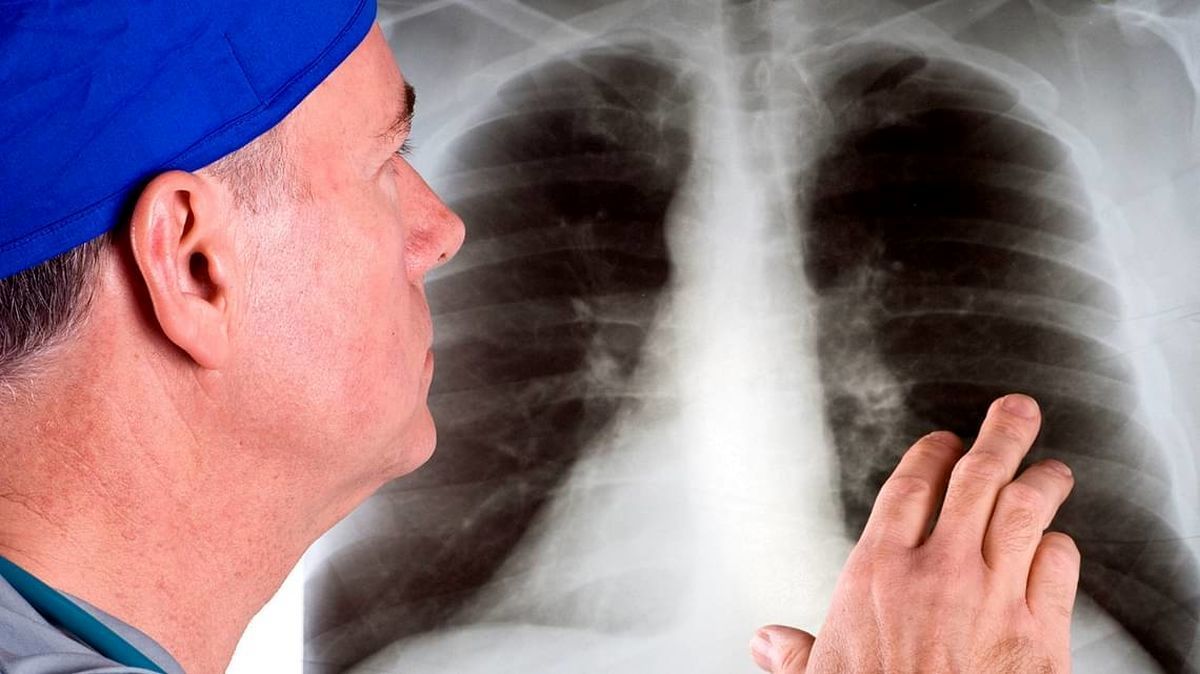 مهمترین علائم سرطان ریه را بشناسید