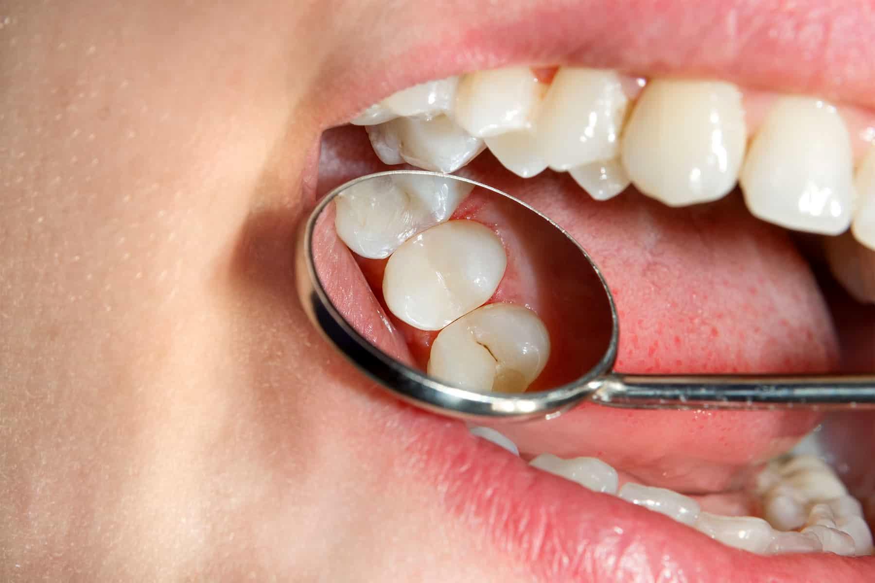 عامل خراب شدن دندان را بشناسید