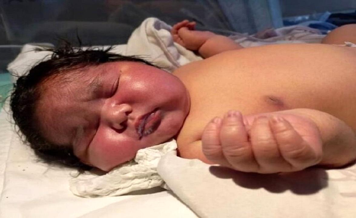 تولد یک نوزاد دختر با دم واقعی 12 سانتیمتری + عکس