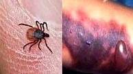 مراقب باشید! شیوع ویروس تب خونریزی‌دهنده کریمه کنگو در ایران