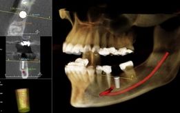 آیا عکس cbct برای کاشت ایمپلنت دندان ضروری است؟