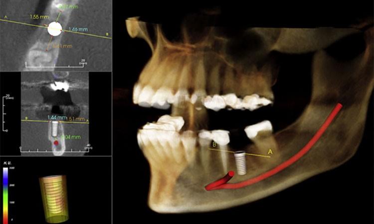 آیا عکس cbct برای کاشت ایمپلنت دندان ضروری است؟
