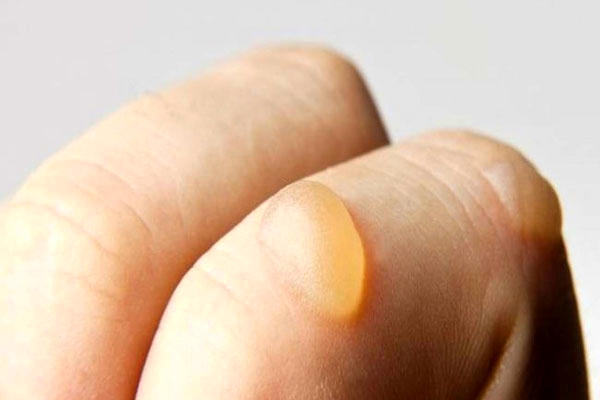 چطور تاول پوستی را درمان کنیم