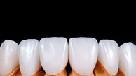 لمینت دندان با 20 درصد تخفیف فقط تا پایان مرداد ماه